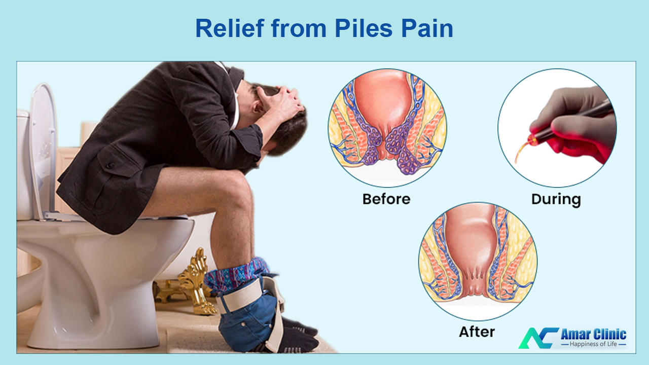 पाइल्स के दर्द को कम करने के उपाय